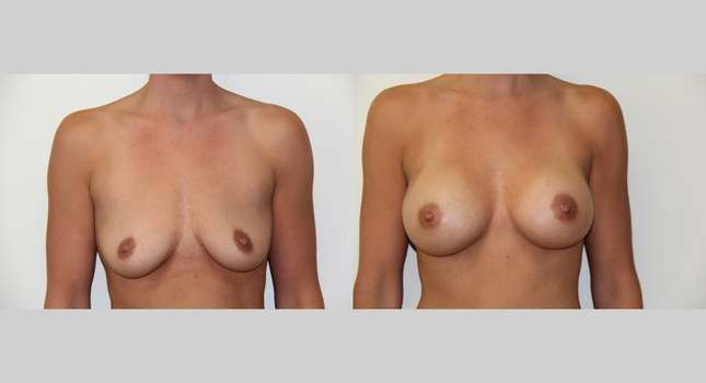 Breast Augmentation: Image #422