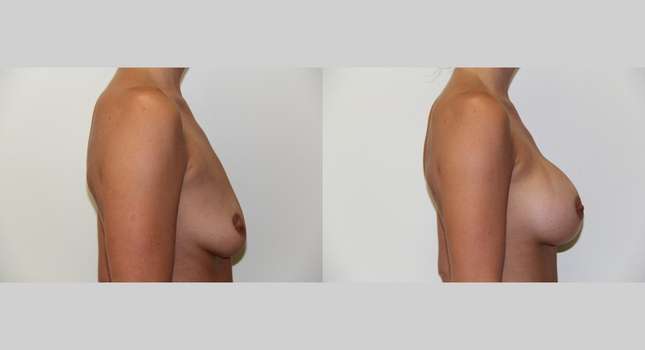 Breast Augmentation: Image #423