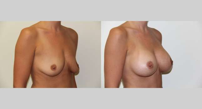 Breast Augmentation: Image #424