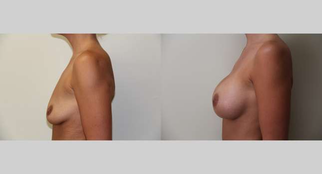 Breast Augmentation: Image #425