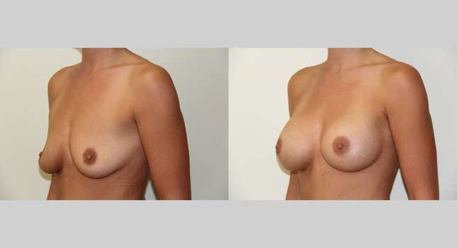 Breast Augmentation: Image #426
