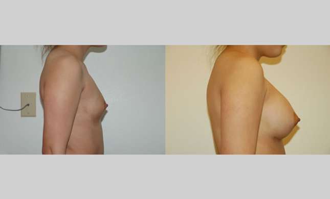 Breast Augmentation: Image #43