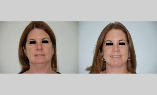 Neck Lift: Image #432