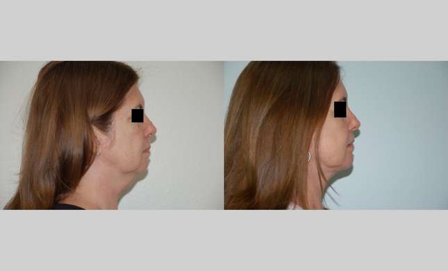 Neck Lift: Image #433