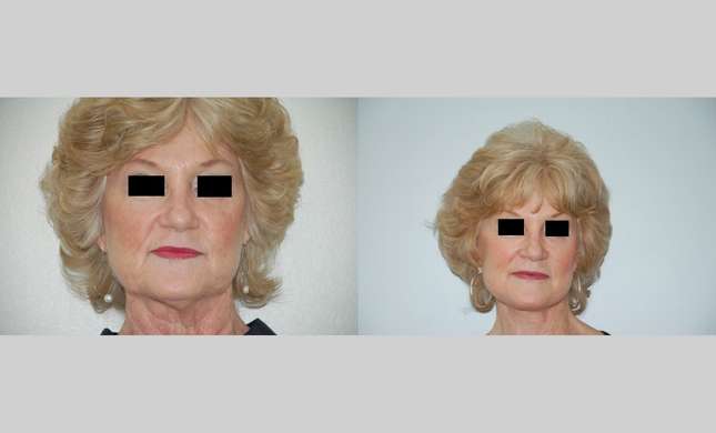 Neck Lift: Image #434