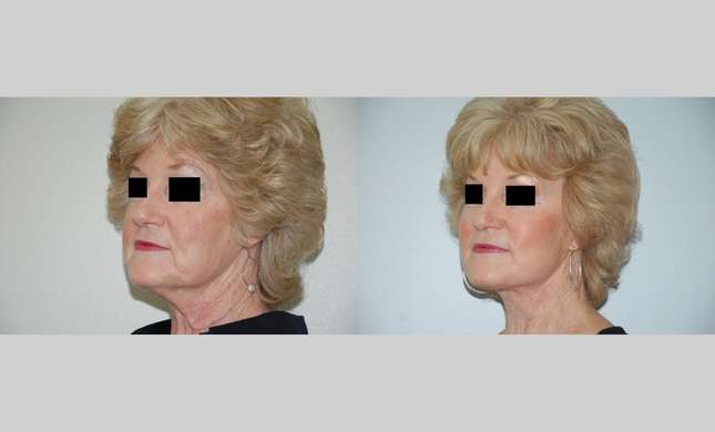 Neck Lift: Image #436