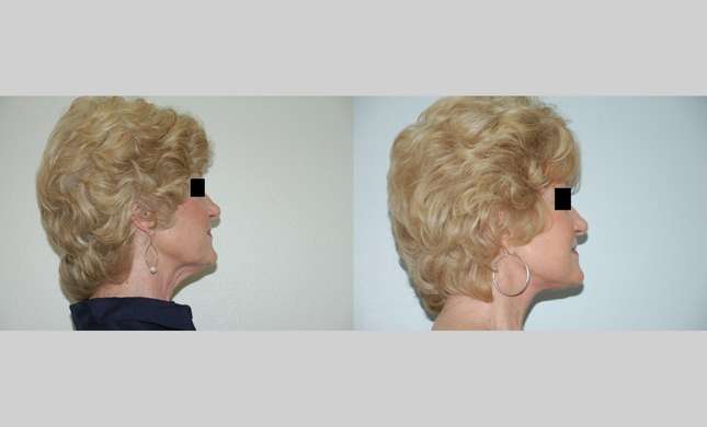 Neck Lift: Image #437