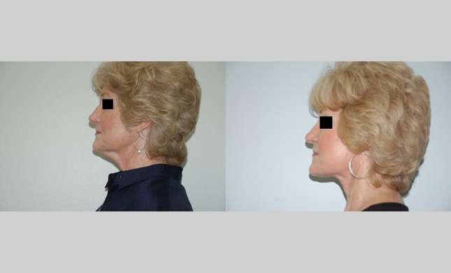Facial Rejuvenation: Image #439
