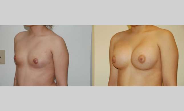 Breast Augmentation: Image #44