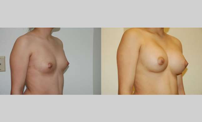 Breast Augmentation: Image #45