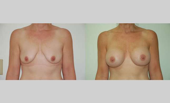 Breast Augmentation: Image #46