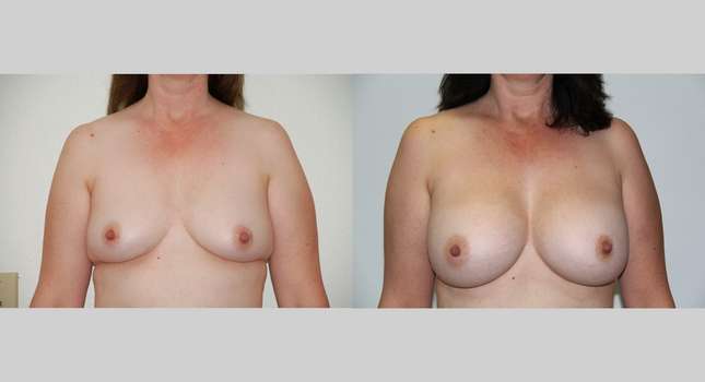 Breast Augmentation: Image #464