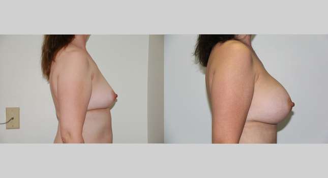 Breast Augmentation: Image #465