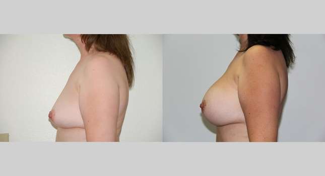 Breast Augmentation: Image #466