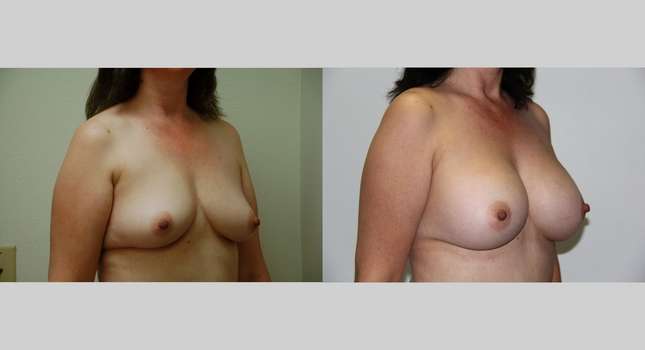 Breast Augmentation: Image #467