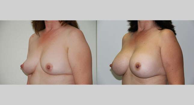 Breast Augmentation: Image #468