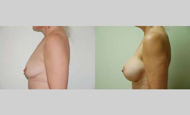 Breast Augmentation: Image #47