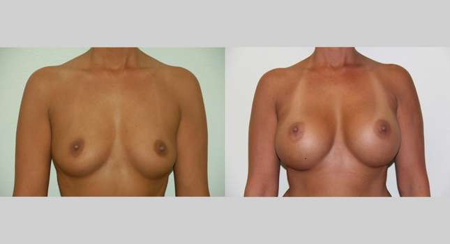 Breast Augmentation: Image #472