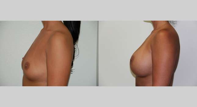 Breast Augmentation: Image #473