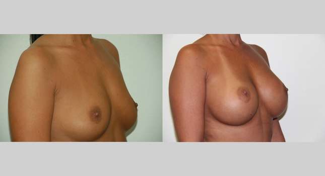 Breast Augmentation: Image #474