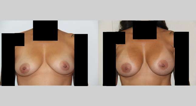 Breast Augmentation: Image #475