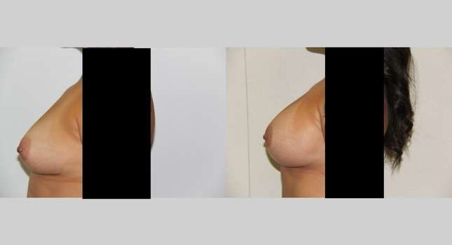 Breast Augmentation: Image #476