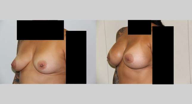 Breast Augmentation: Image #477