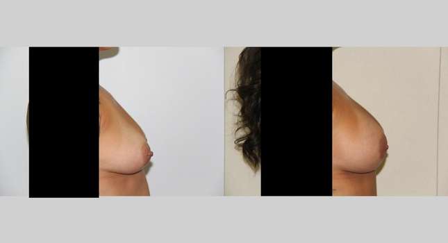 Breast Augmentation: Image #478