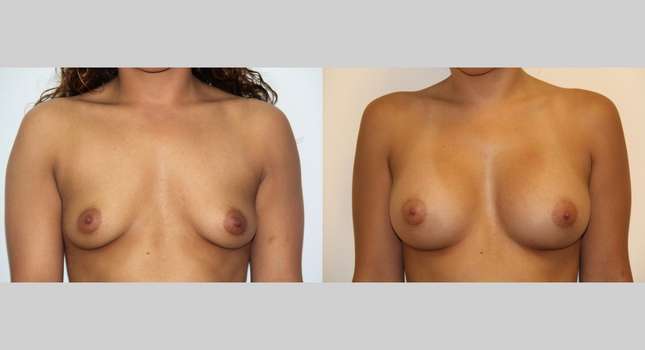Breast Augmentation: Image #479
