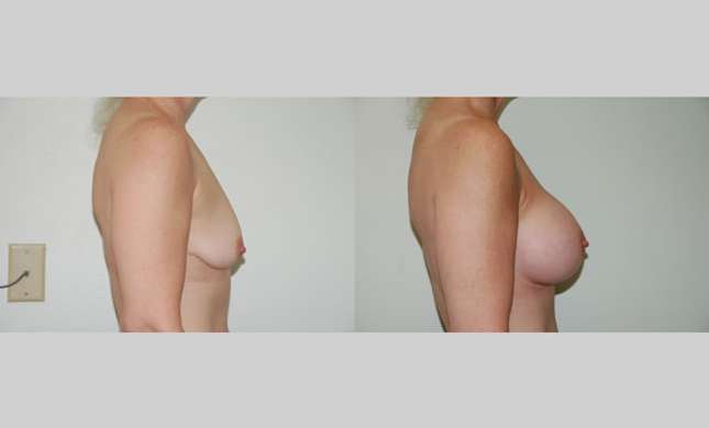 Breast Augmentation: Image #48