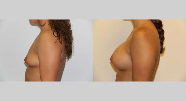 Breast Augmentation: Image #480