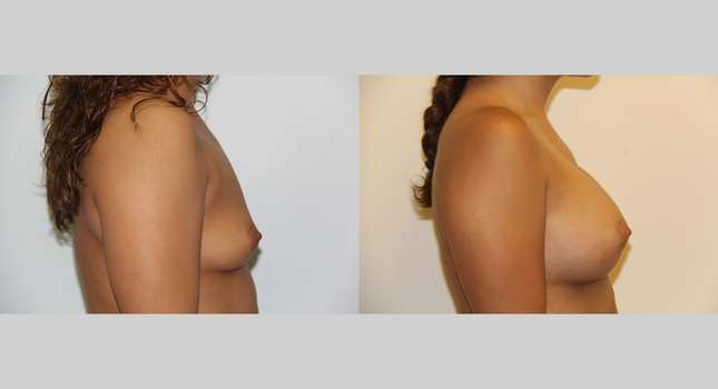 Breast Augmentation: Image #481