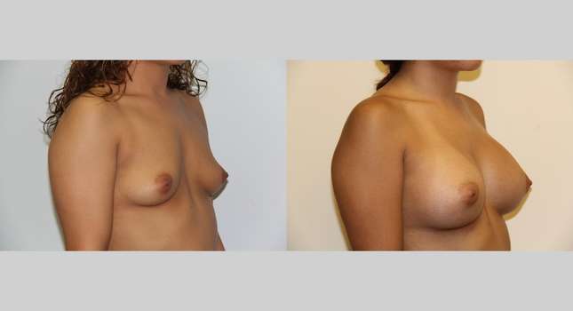 Breast Augmentation: Image #482