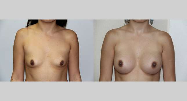 Breast Augmentation: Image #483