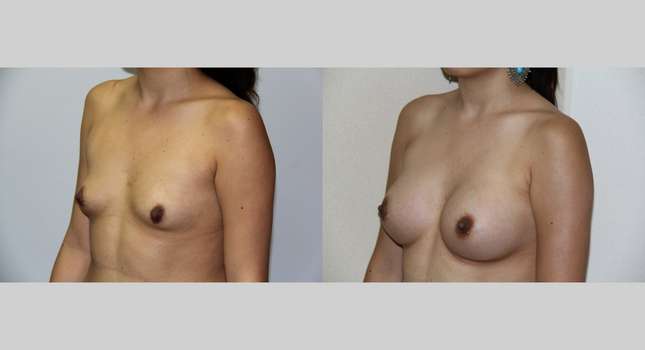 Breast Augmentation: Image #484