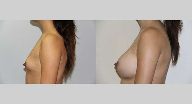Breast Augmentation: Image #485