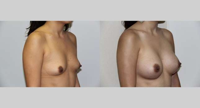 Breast Augmentation: Image #486