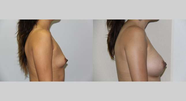 Breast Augmentation: Image #487