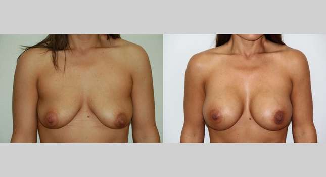 Breast Augmentation: Image #488