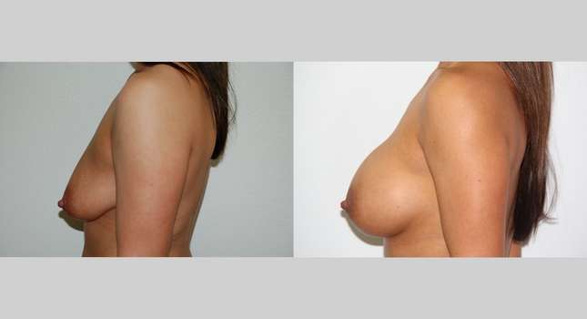Breast Augmentation: Image #489