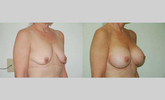 Breast Augmentation: Image #49