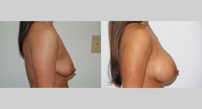 Breast Augmentation: Image #490