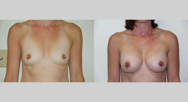Breast Augmentation: Image #491