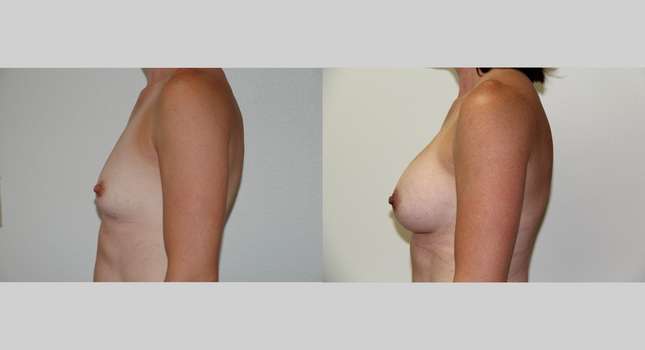 Breast Augmentation: Image #492