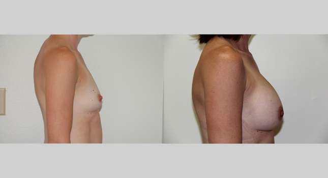 Breast Augmentation: Image #493