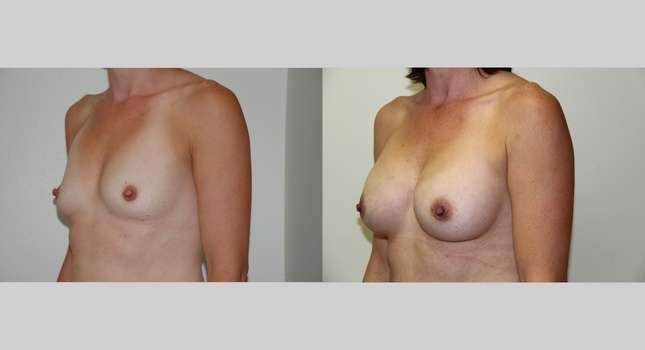 Breast Augmentation: Image #494