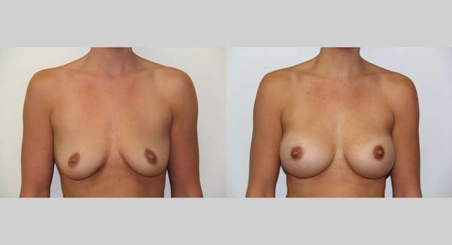 Breast Augmentation: Image #495