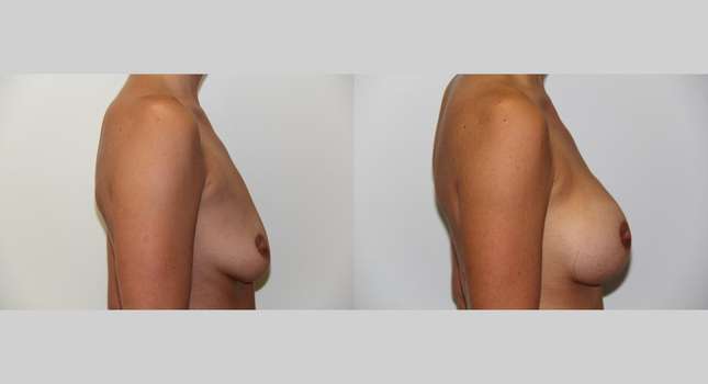 Breast Augmentation: Image #496