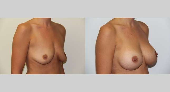 Breast Augmentation: Image #497