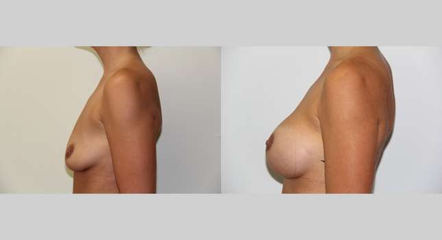 Breast Augmentation: Image #499
